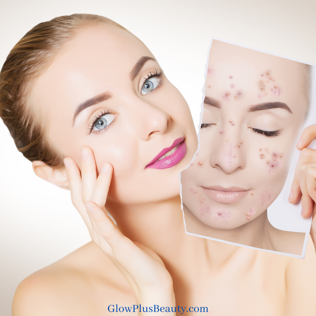 Top 10 Acne mistakes you are doing right now