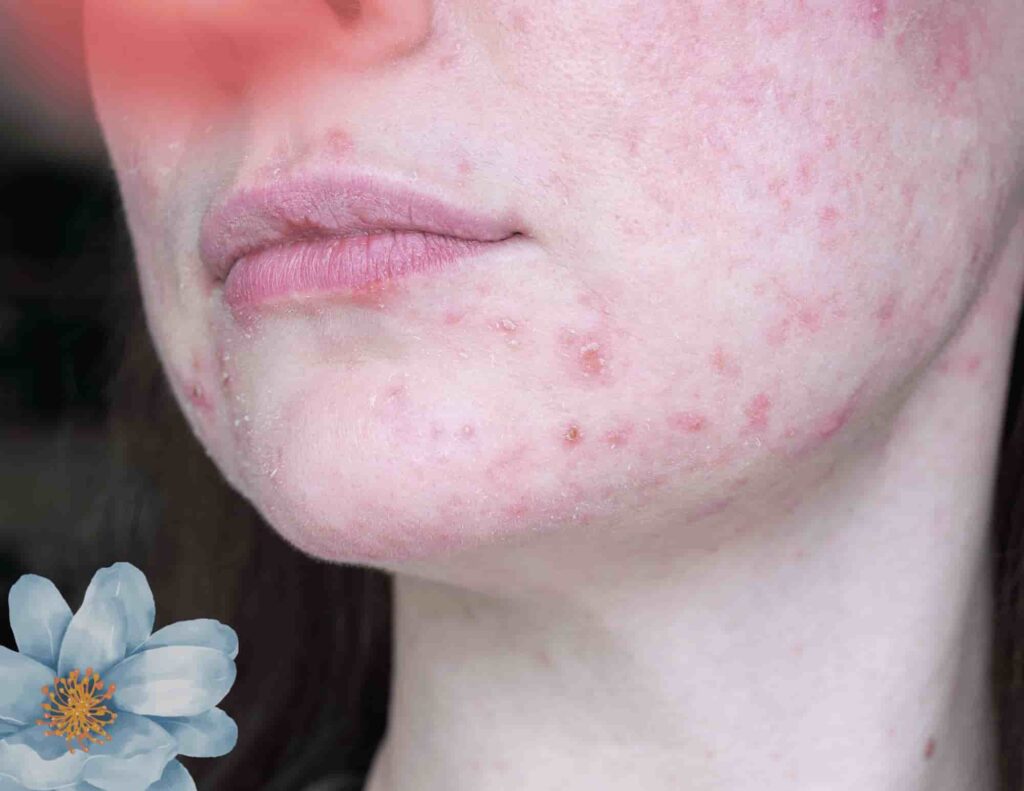 Does Proactiv Work For Hormonal Acne?