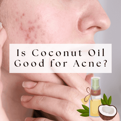 Is Coconut Oil Good for Acne?