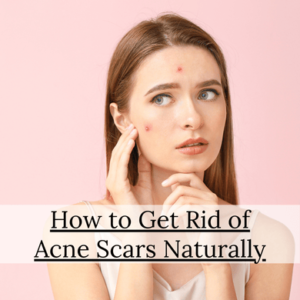 How to Get Rid of Acne Scars Naturally